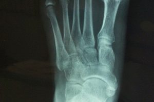 What is a Foot Fracture